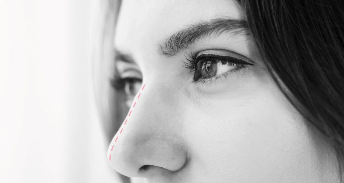Rinoplastia