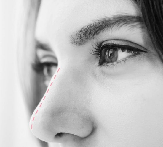 Rinoplastia